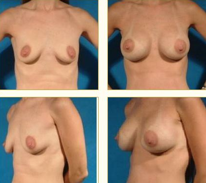 Breast Augmentation Houston