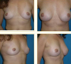 Breast Augmentation Houston