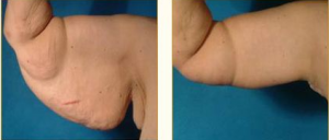 Arm Lift Houston Before and After