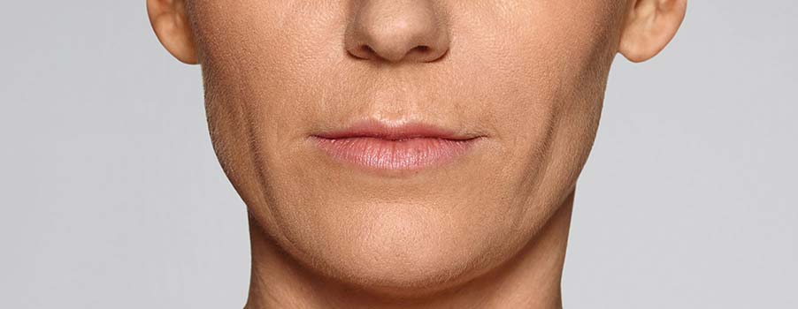 Restylane Defyne after