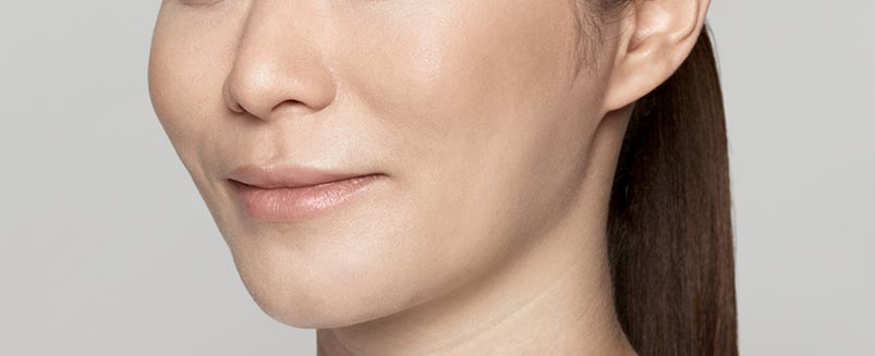 Restylane Lyft after