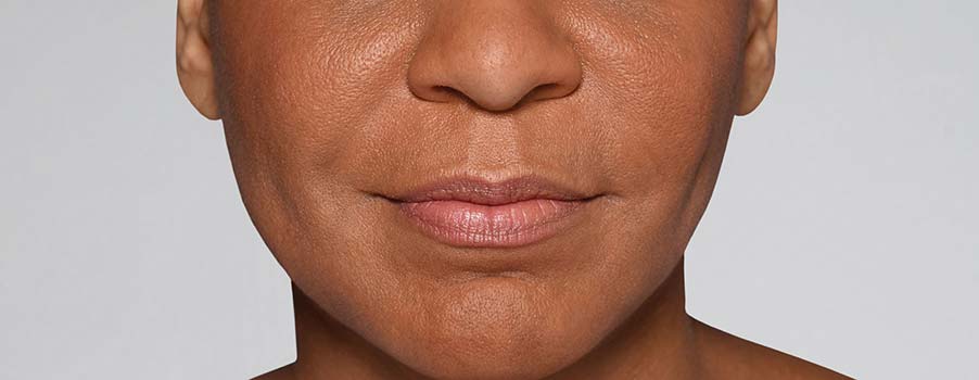 Restylane Refyne after
