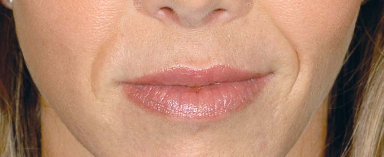 Restylane before
