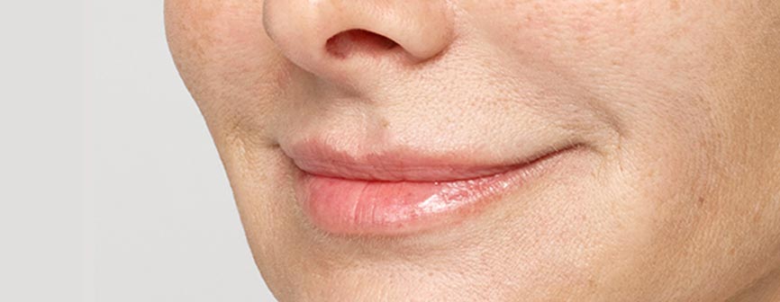 Restylane Silk after